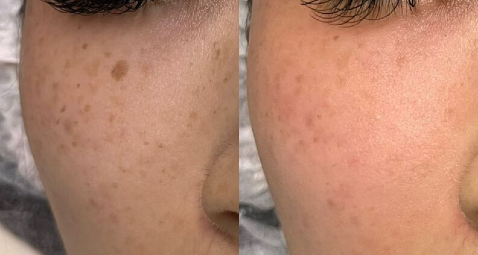 Pico Laser untuk Flek Hitam di Wajah
