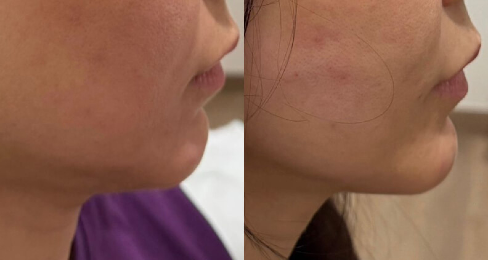 Solusi Anti-Aging dengan Collagen Stimulator