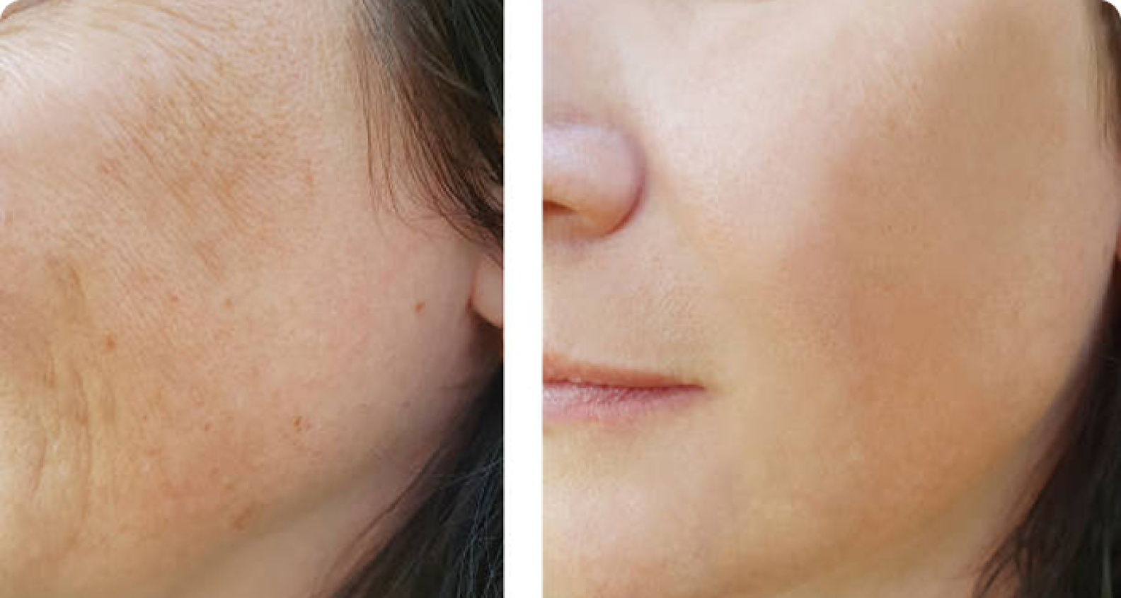 Contoh before after