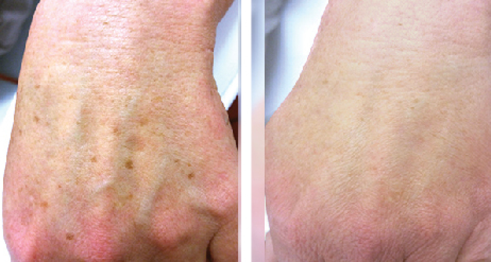 Pico Laser Treatment di Area Tangan