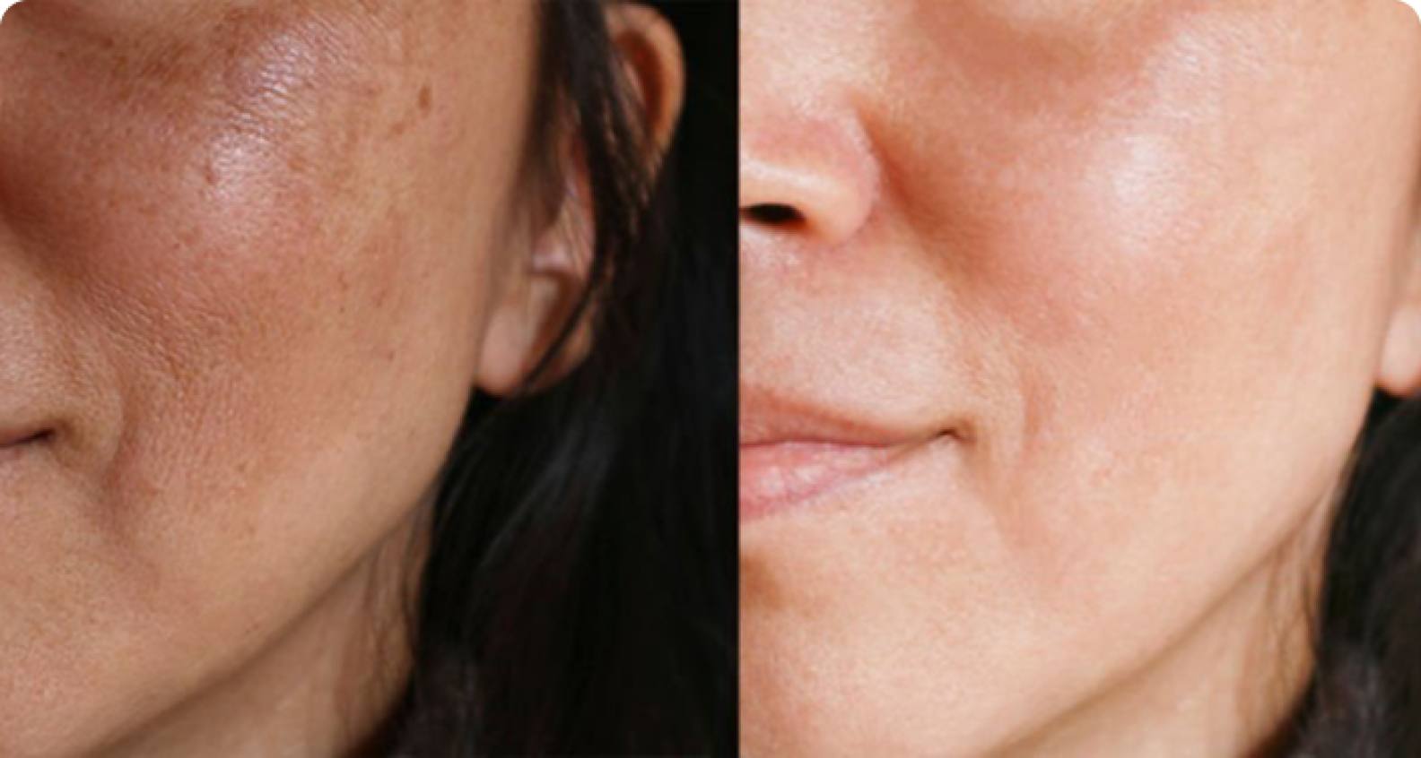 Salmon DNA Skin Booster Treatment
