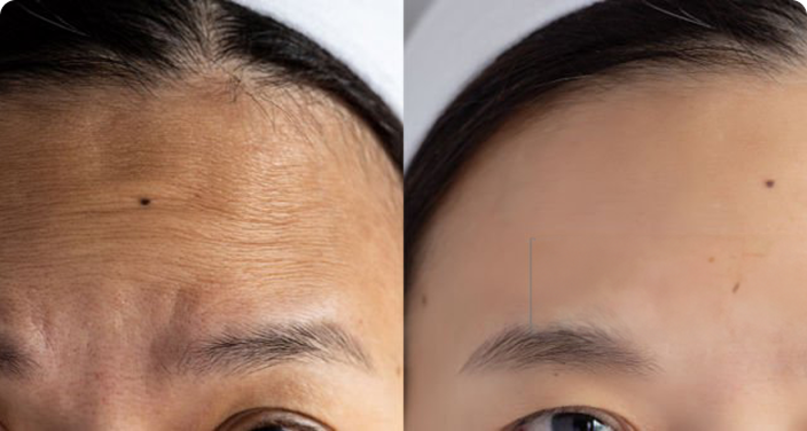 Botox Injection
