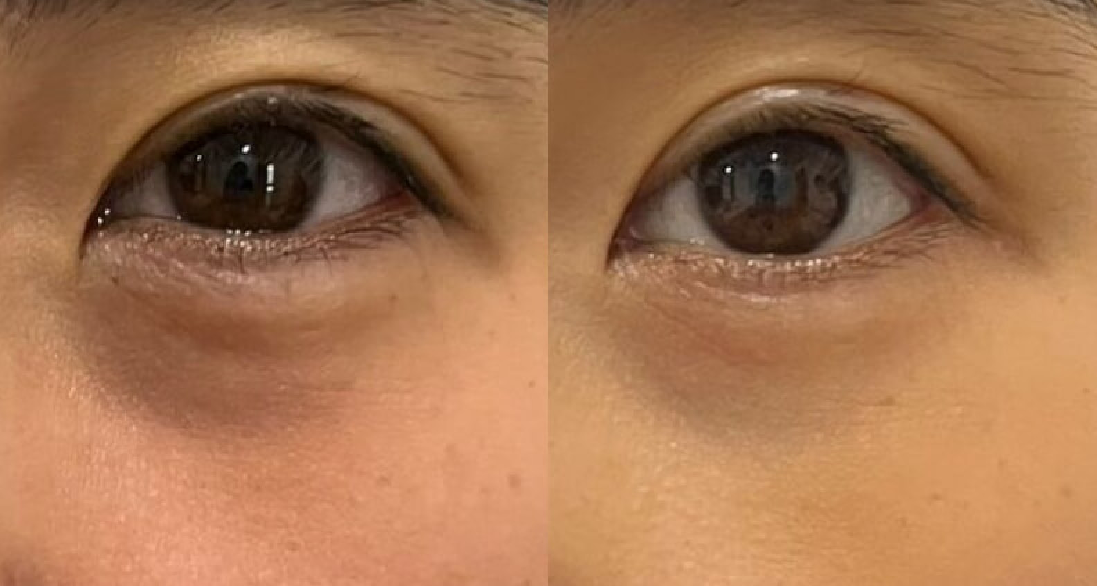 Under Eye Filler Untuk Mata Panda
