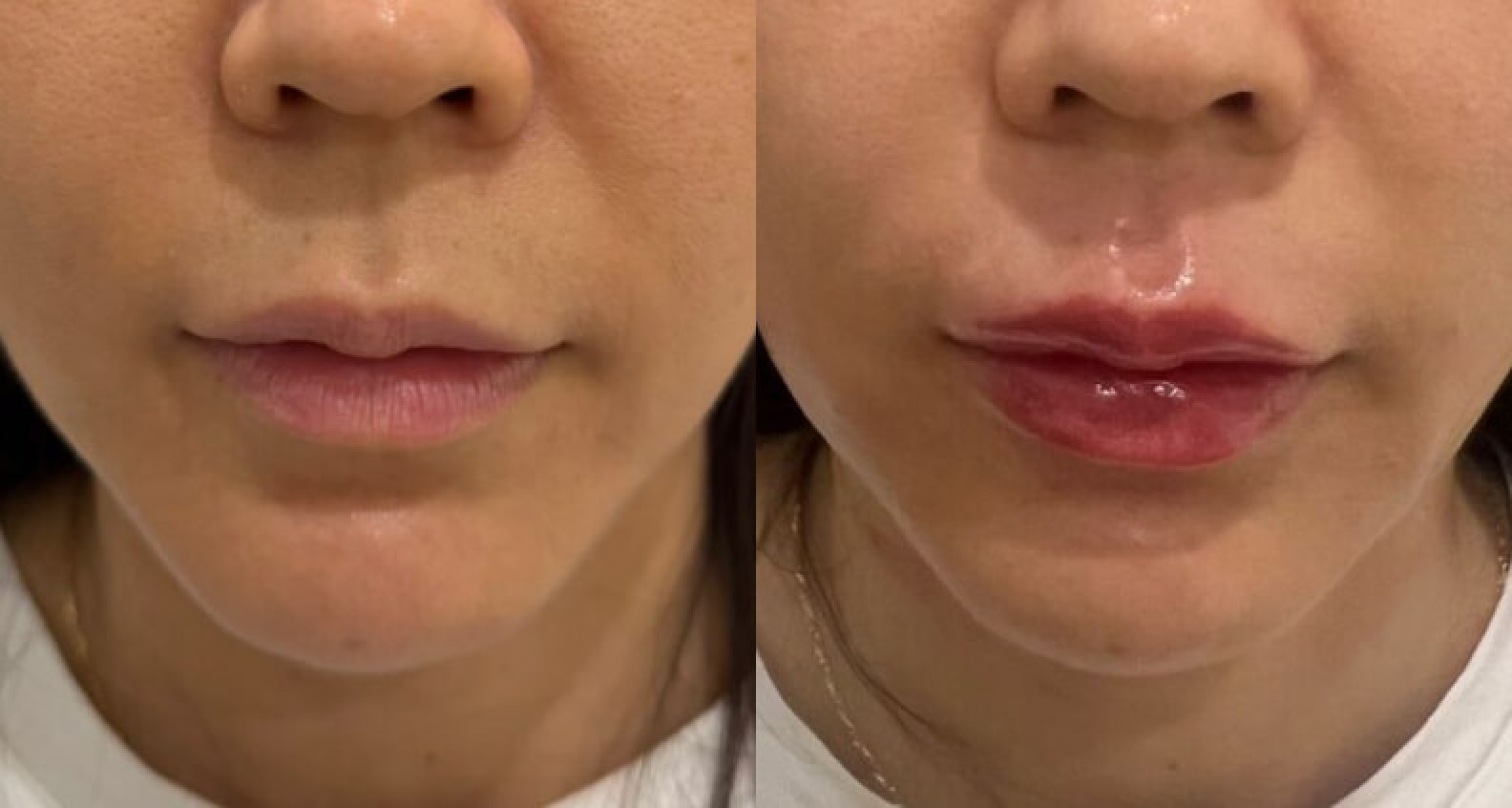 Hasil Lip Filler