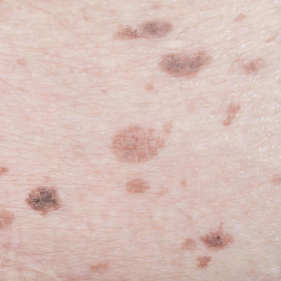 Melasma 1