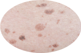 Melasma